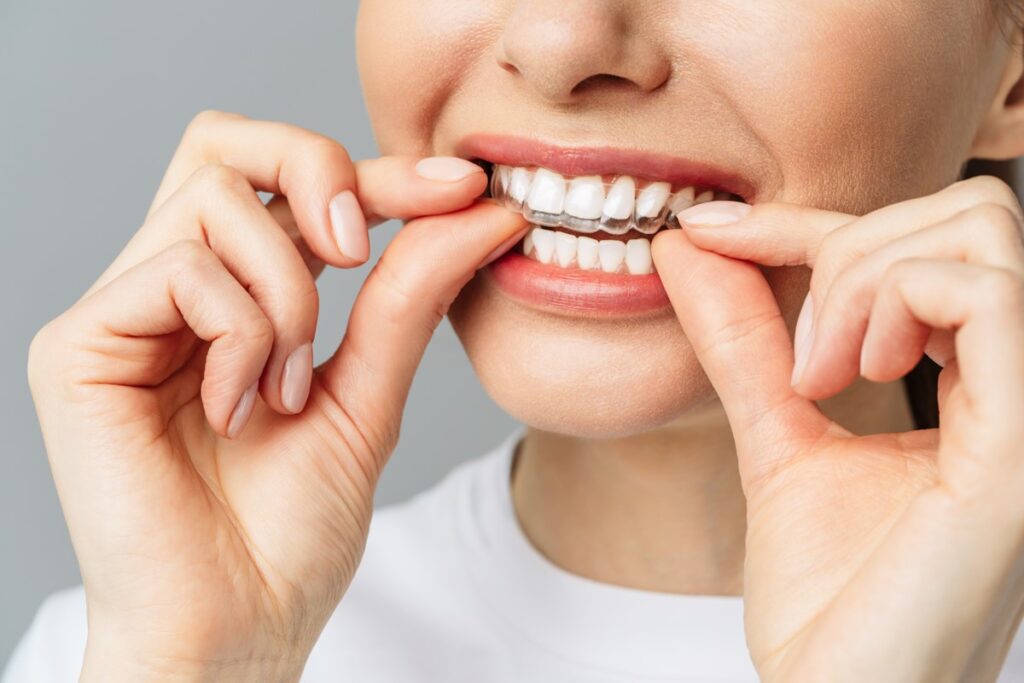 Invisalign vs Braces: Choosing the Right Teeth Straightening Option for You